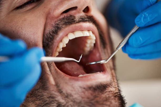 Best Emergency Wisdom Teeth Removal in Wfield, IN